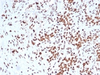 IHC staining of FFPE human Ewing sarcoma with SMARCB1 antibody (clone rSMARCB1/4588). HIER: boil tis