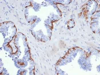 IHC staining of FFPE human prostate carcinoma tissue with recombinant Keratin 5 antibody (clone KRT5