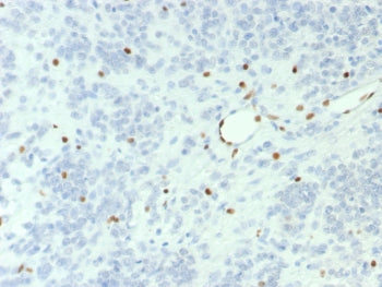 IHC staining of FFPE human ovarian small cell carcinoma with BRG1 antibody (clone BRG1/7633R). HIER: