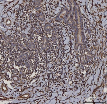 IHC staining of FFPE human infiltrating breast cancer tissue with HLA-DRA antibody. HIER: boil tissu