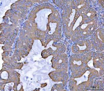 IHC staining of FFPE human ovarian cancer tissue with SEPT7 antibody. HIER: boil tissue sections in 