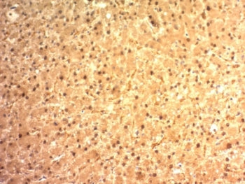 IHC: Formalin-fixed, paraffin-embedded human hepatocellular carcinoma stained with Glypican-3 antibo