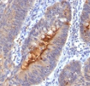 IHC testing of human colon carcinoma and Secretory Component antibody (SC05).