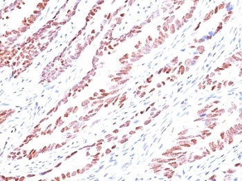 IHC analysis of formalin-fixed, paraffin-embedded human colon carcinoma stained with p57 antibody (K