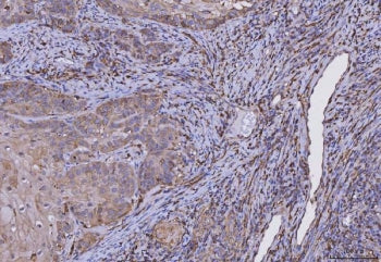 IHC staining of FFPE human laryngeal squamous cell carcinoma tissue with HLA-DRA antibody. HIER: boi