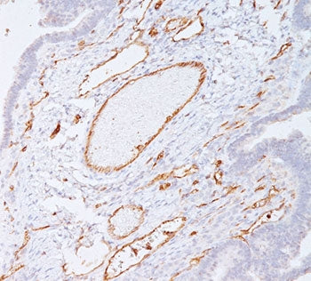 IHC staining of colon carcinoma with PECAM-1 antibody (clone C31.7). Note cell membrane staining of 