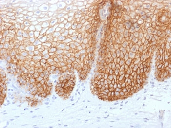 IHC testing of FFPE human cervical carcinoma with recombinant CD44v9 antibody (clone rCD44v9/1459). 