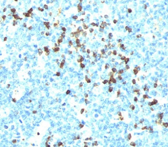 IHC testing of tonsil stained with Lambda Light Chain antibody (LcN-2). Note cell membrane & cytopla