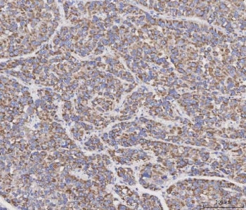 IHC staining of FFPE human liver cancer tissue with MAD2B antibody. HIER: boil tissue sections in pH