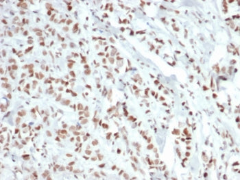 IHC staining of FFPE human breast carcinoma tissue with recombinant Estrogen Receptor alpha antibody