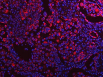 Immunofluorescent staining of FFPE human lung cancer tissue with TAPP-1 antibody (red) and DAPI nucl