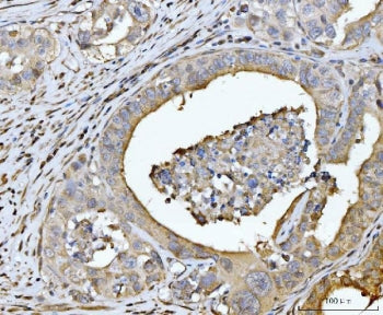 IHC staining of FFPE human appendiceal adenocarcinoma tissue with EDEM3 antibody. HIER: boil tissue 