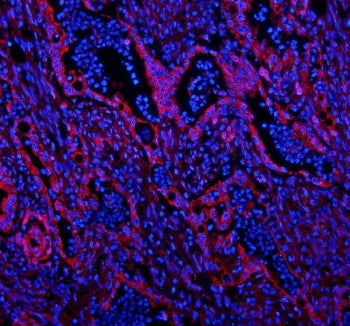 Immunofluorescent staining of FFPE rectal cancer with Caveolin-2 antibody (red) and DAPI nuclear sta