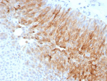 IHC staining of FFPE human bladder carcinoma with Uroplakin 1A antibody (clone UPK1A/8704R). HIER: b