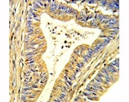 IHC analysis of FFPE human colon carcinoma stained with SOD1 antibody