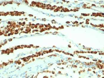 IHC staining of FFPE human lung adenocarcinoma tissue with recombinant NAPSA antibody antibody (clon