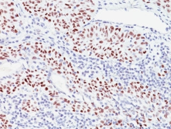 IHC analysis of formalin-fixed, paraffin-embedded human bladder carcinoma stained with p57 antibody 