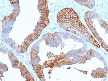 IHC staining of FFPE human prostate cancer with HLA-DR antibody (clone TAL 1B5). HIER: boil tissue s