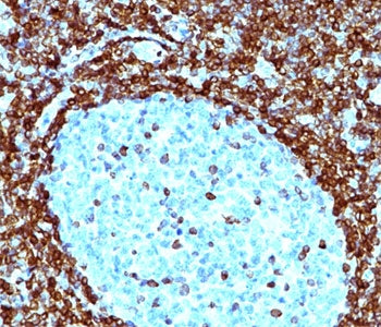 IHC testing of human non-Hodgkin's lymphoma stained with Bcl-2 antibody (clone 124). Note nuclear me