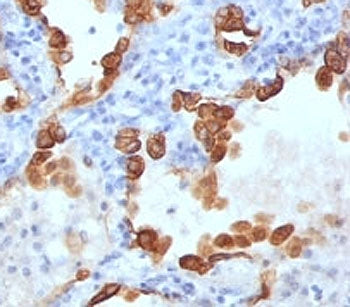 IHC: Formalin-fixed, paraffin-embedded human lung carcinoma stained with Cytokeratin 8/18 antibody (