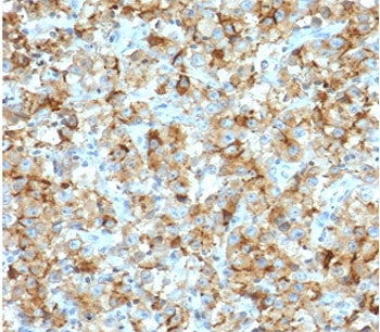 IHC staining of FFPE human testicular carcinoma with StAR antibody (clone SARP1-1). Required HIER: b