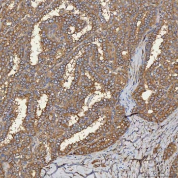IHC staining of FFPE human thyroid cancer tissue with SEC31A antibody. HIER: boil tissue sections in