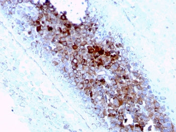 IHC staining of FFPE human melanoma with CD63 antibody (clone LAMP3/2789). HIER: boil tissue section