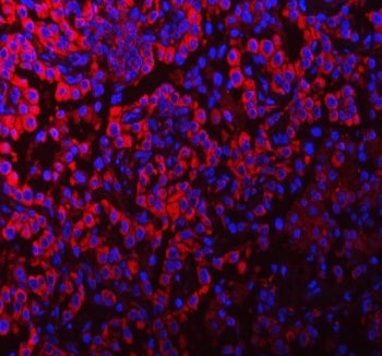 Immunofluorescent staining of FFPE human lung cancer tissue with PACSIN2 antibody (red) and DAPI nuc