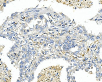 IHC staining of FFPE human lung cancer with Endothelin A Receptor antibody. HIER: boil tissue sectio