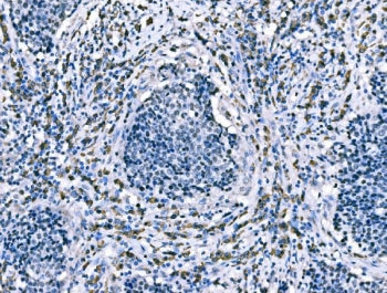 IHC staining of FFPE human lung cancer tissue with CD101 antibody. HIER: boil tissue sections in pH8