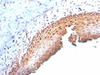 IHC staining of FFPE human cervix with p16INK4a antibody (clone CDKN2A/3830). HIER: boil tissue sect