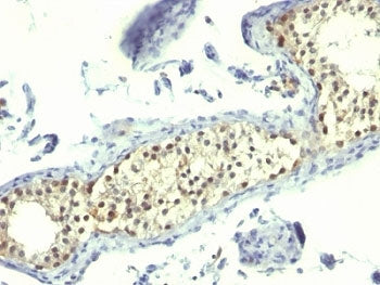 IHC: Formalin-fixed, paraffin-embedded human testicular carcinoma stained with Thymidylate Synthase 