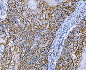 IHC staining of FFPE human laryngeal squamous cell carcinoma tissue with CD44 antibody. HIER: boil t