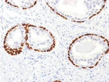 IHC testing of FFPE human prostate cancer tissue with p63 antibody. Required HIER: boil tissue secti