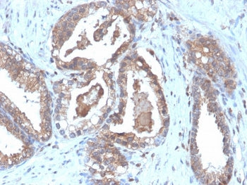 IHC staining of FFPE human prostate carcinoma tissue with recombinant CD47 antibody (clone CD47/6364