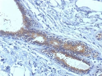IHC testing of FFPE human breast carcinoma tissue with BRCA1 antibody (clone BRCA1/1398). HIER: boil