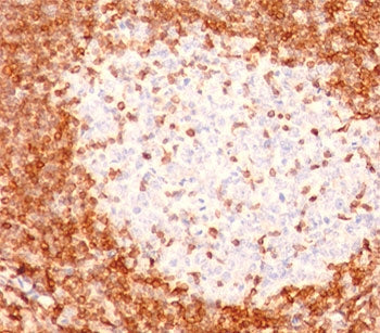 IHC testing of human tonsil stained with Bcl-2 antibody (8C8).Note cell membrane and cytoplasmic sta