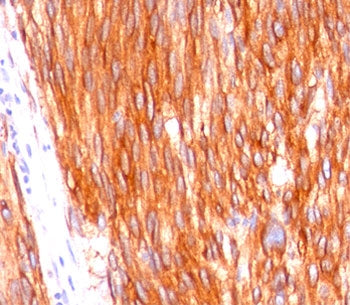 Formalin-paraffin human gastrointestinal stromal tumor (GIST) stained with CD117 antibody (clone C11
