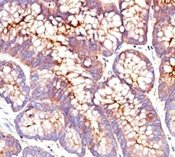 IHC: Formalin-fixed, paraffin-embedded human colon carcinoma stained with CEA antibody (SPM541)