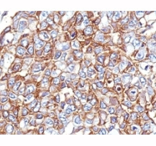 IHC: Formalin-fixed, paraffin-embedded human breast carcinoma stained with EpCAM antibody cocktail (