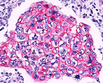 Formalin/paraffin breast ductal carcinoma stained with beta-Catenin antibody. Note membrane staining