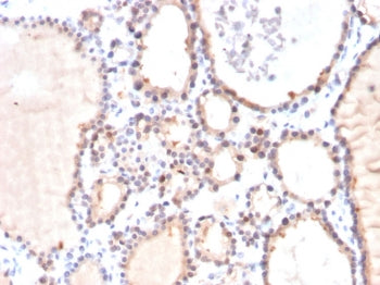 IHC testing of FFPE human thyroid carcinoma stained with Glyoxalase 1 antibody (clone CPTC-GLO1-3). 