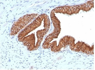 IHC staining of FFPE human prostate carcinoma tissue with IGF1R antibody (clone IGF1R/4667). HIER: b