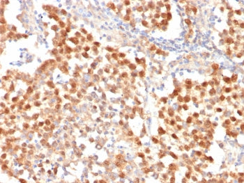 IHC staining of FFPE human seminoma tissue with Octamer-binding protein 4 antibody (clone OCT4/7347R