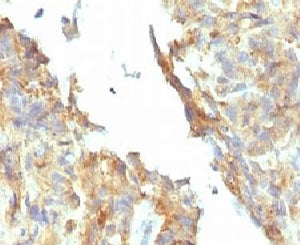 IHC testing of FFPE ovarian carcinoma and Alkaline Phosphatase antibody (KSUL-1). Required HIER: boi