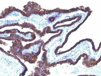 IHC: Formalin-fixed, paraffin-embedded human ovarian cancer stained with Cytokeratin 8/18 antibody (