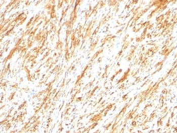 IHC: Formalin-fixed, paraffin-embedded human schwanoma stained with Glial Fibrillary Acidic Protein 