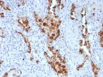 IHC staining of FFPE human lung adenocarcinoma with Napsin A antibody (clone NAPSA/3307). HIER: boil