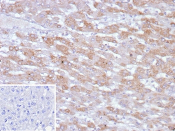 IHC staining of FFPE human hepatocellular carcinoma tissue with PHPT1 antibody (clone PHPT1/12053). 