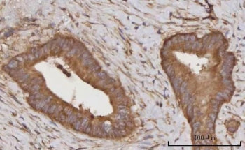 IHC staining of FFPE human rectum adenocarcinoma tissue with C-C motif chemokine 23 antibody. HIER: 